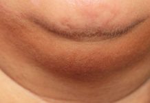 5 enfermedades que te sacan papada y todavía no lo sabes – MSN