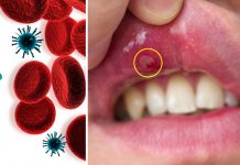 10 razones por las que salen aftas en la boca y cómo curarlas rápido – Salud180