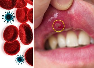 10 razones por las que salen aftas en la boca y cómo curarlas rápido – Salud180