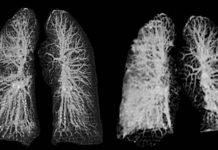 Coronavirus: así afecta los pulmones de los 4 tipos de pacientes – Fayerwayer