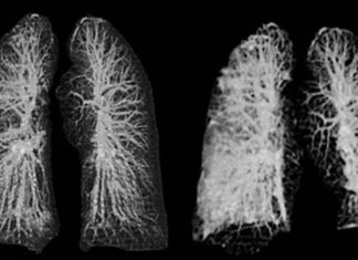 Coronavirus: así afecta los pulmones de los 4 tipos de pacientes – Fayerwayer